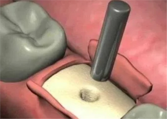 最詳細(xì)的種植牙流程 最詳細(xì)的種植牙流程