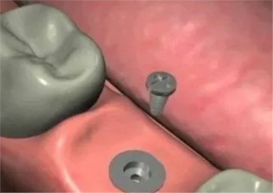 最詳細(xì)的種植牙流程 最詳細(xì)的種植牙流程