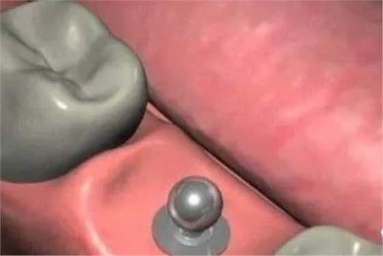 最詳細(xì)的種植牙流程 最詳細(xì)的種植牙流程