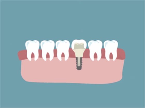 最詳細(xì)的種植牙流程 最詳細(xì)的種植牙流程