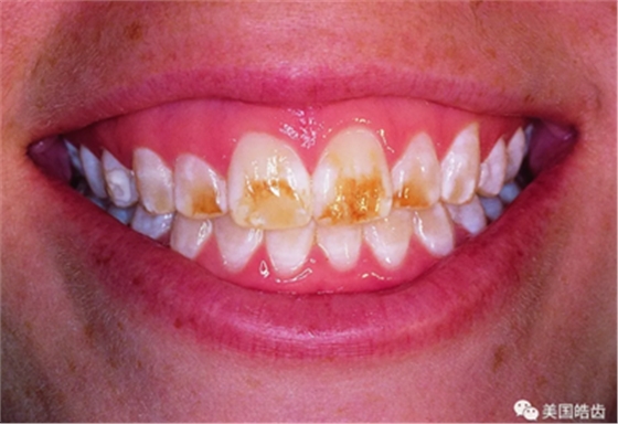 氟斑牙的克星--美國皓齒微創(chuàng)治療法 氟斑牙的克星--美國皓齒微創(chuàng)治療法