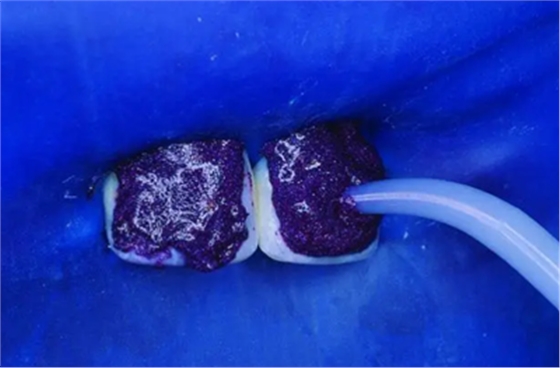 氟斑牙的克星--美國皓齒微創(chuàng)治療法 氟斑牙的克星--美國皓齒微創(chuàng)治療法