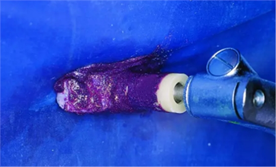 氟斑牙的克星--美國皓齒微創(chuàng)治療法 氟斑牙的克星--美國皓齒微創(chuàng)治療法