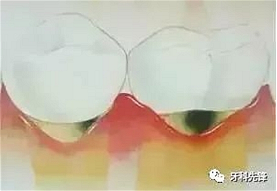 	牙齦萎縮是不治之癥？緩解牙齦萎縮5步走！