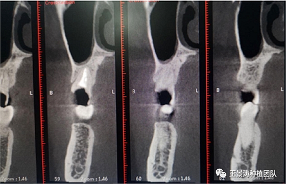 后牙區(qū)即刻種植的適應(yīng)癥的思考 后牙區(qū)即刻種植的適應(yīng)癥的思考