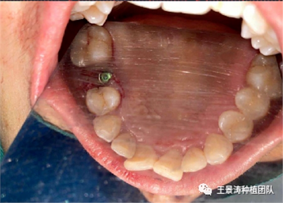 后牙區(qū)即刻種植的適應(yīng)癥的思考 后牙區(qū)即刻種植的適應(yīng)癥的思考