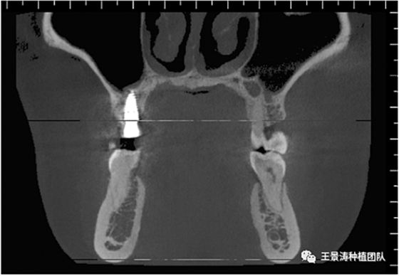 后牙區(qū)即刻種植的適應(yīng)癥的思考 后牙區(qū)即刻種植的適應(yīng)癥的思考
