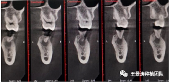 后牙區(qū)即刻種植的適應(yīng)癥的思考 后牙區(qū)即刻種植的適應(yīng)癥的思考