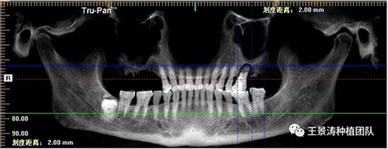 后牙區(qū)即刻種植的適應(yīng)癥的思考 后牙區(qū)即刻種植的適應(yīng)癥的思考