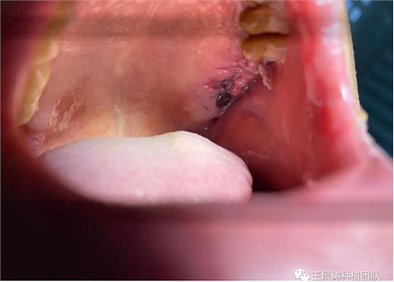 后牙區(qū)即刻種植的適應(yīng)癥的思考 后牙區(qū)即刻種植的適應(yīng)癥的思考