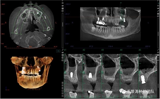 后牙區(qū)即刻種植的適應(yīng)癥的思考 后牙區(qū)即刻種植的適應(yīng)癥的思考