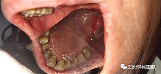 后牙區(qū)即刻種植的適應(yīng)癥的思考 后牙區(qū)即刻種植的適應(yīng)癥的思考