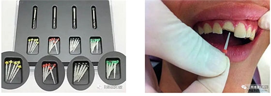 口腔科普 | 殘根殘冠怎么辦——樁核冠 口腔科普 | 殘根殘冠怎么辦——樁核冠