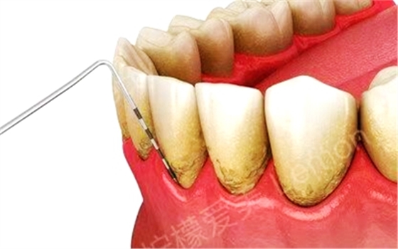牙周病總是來勢(shì)洶洶？有辦法預(yù)防嗎？