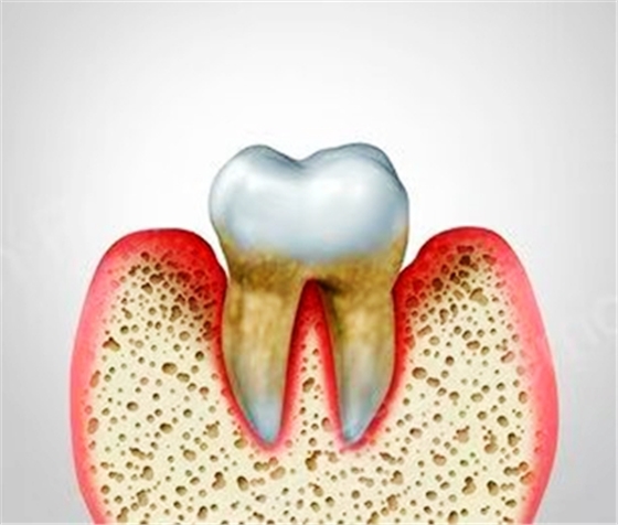 牙周病總是來勢(shì)洶洶？有辦法預(yù)防嗎？