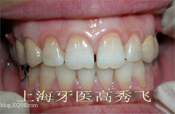 圖解后牙精密附著體修復(fù)2例(原創(chuàng)) 圖解后牙精密附著體修復(fù)2例(原創(chuàng))