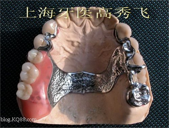 圖解后牙精密附著體修復(fù)2例(原創(chuàng)) 圖解后牙精密附著體修復(fù)2例(原創(chuàng))