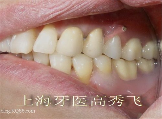 圖解后牙精密附著體修復(fù)2例(原創(chuàng)) 圖解后牙精密附著體修復(fù)2例(原創(chuàng))