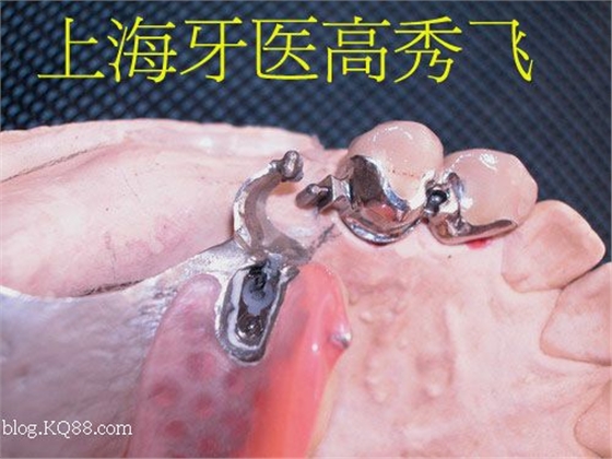 圖解后牙精密附著體修復(fù)2例(原創(chuàng)) 圖解后牙精密附著體修復(fù)2例(原創(chuàng))