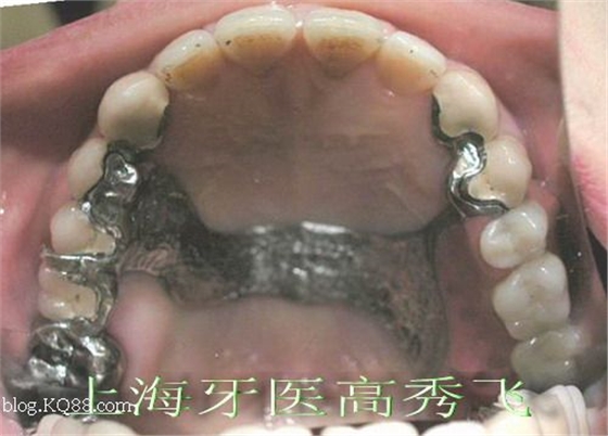 圖解后牙精密附著體修復(fù)2例(原創(chuàng)) 圖解后牙精密附著體修復(fù)2例(原創(chuàng))