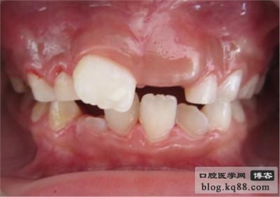 齦瓣切除助萌術(shù)---王大力醫(yī)生 齦瓣切除助萌術(shù)---王大力醫(yī)生