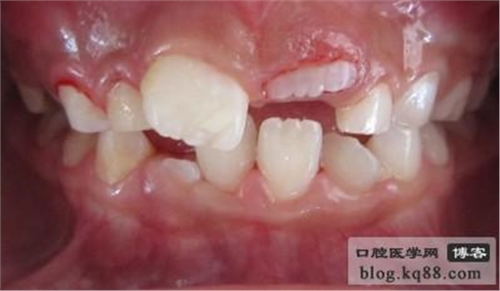 齦瓣切除助萌術(shù)---王大力醫(yī)生 齦瓣切除助萌術(shù)---王大力醫(yī)生