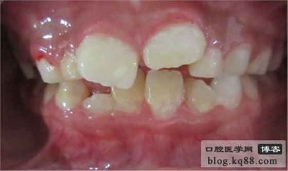 齦瓣切除助萌術(shù)---王大力醫(yī)生 齦瓣切除助萌術(shù)---王大力醫(yī)生