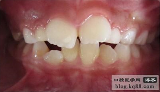 齦瓣切除助萌術(shù)---王大力醫(yī)生 齦瓣切除助萌術(shù)---王大力醫(yī)生