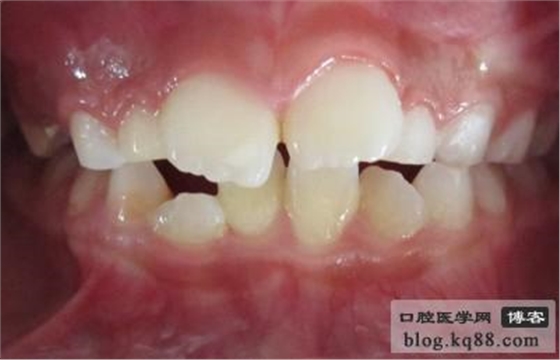齦瓣切除助萌術(shù)---王大力醫(yī)生 齦瓣切除助萌術(shù)---王大力醫(yī)生
