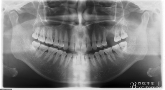 上頜竇外提一例 上頜竇外提一例