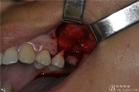 上頜竇外提一例 上頜竇外提一例