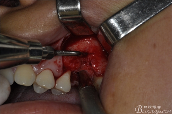 上頜竇外提一例 上頜竇外提一例