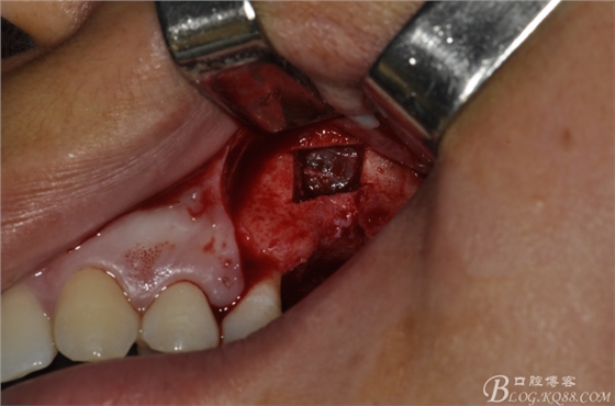 上頜竇外提一例 上頜竇外提一例