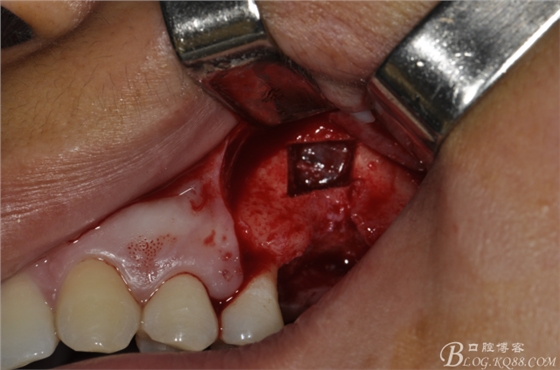 上頜竇外提一例 上頜竇外提一例