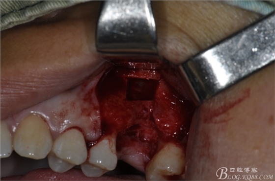 上頜竇外提一例 上頜竇外提一例