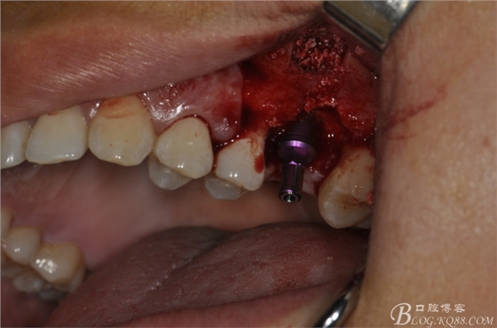 上頜竇外提一例 上頜竇外提一例