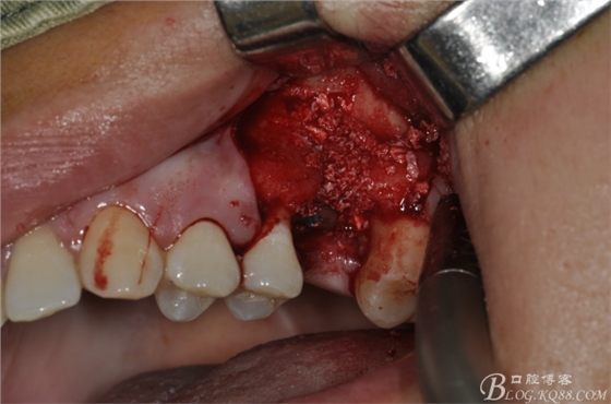 上頜竇外提一例 上頜竇外提一例