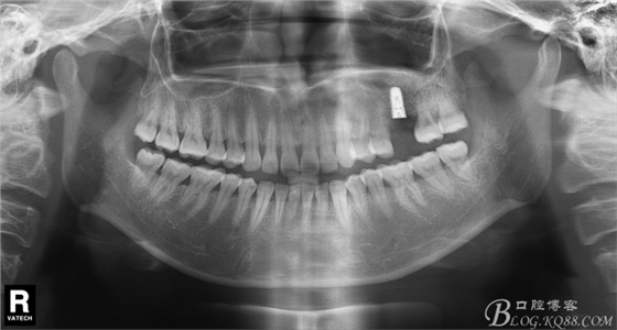 上頜竇外提一例 上頜竇外提一例