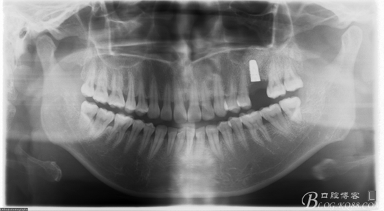 上頜竇外提一例 上頜竇外提一例