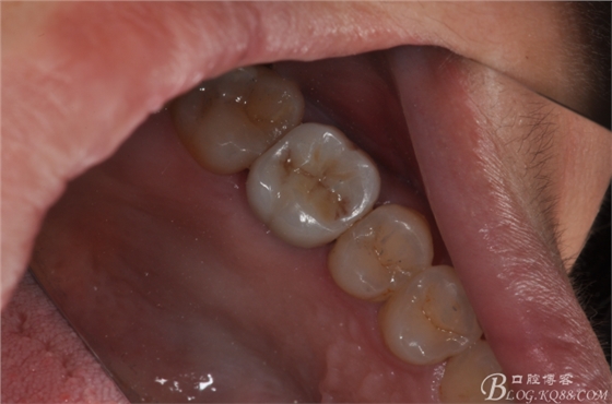 上頜竇外提一例 上頜竇外提一例