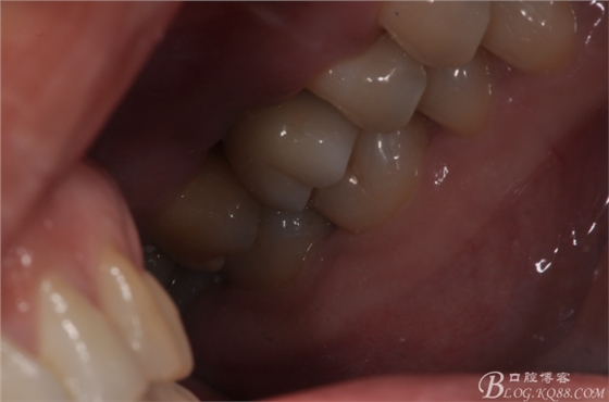 上頜竇外提一例 上頜竇外提一例