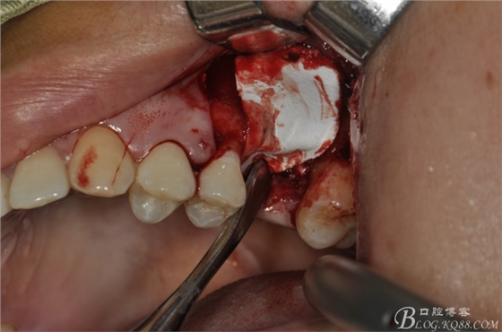 上頜竇外提一例 上頜竇外提一例