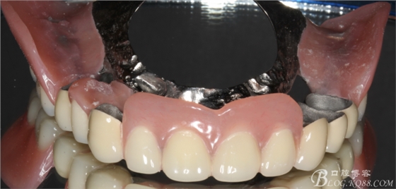 重度牙周炎的咬合重建修復(fù)兩年后效果--塘沽牙醫(yī)吳世超 重度牙周炎的咬合重建修復(fù)兩年后效果--塘沽牙醫(yī)吳世超