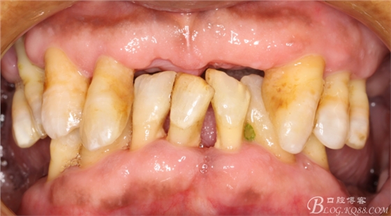 重度牙周炎的咬合重建修復(fù)兩年后效果--塘沽牙醫(yī)吳世超 重度牙周炎的咬合重建修復(fù)兩年后效果--塘沽牙醫(yī)吳世超