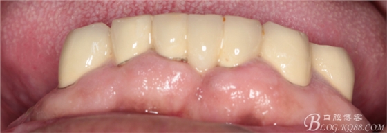 重度牙周炎的咬合重建修復(fù)兩年后效果--塘沽牙醫(yī)吳世超 重度牙周炎的咬合重建修復(fù)兩年后效果--塘沽牙醫(yī)吳世超