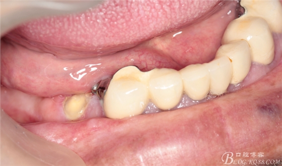 重度牙周炎的咬合重建修復(fù)兩年后效果--塘沽牙醫(yī)吳世超 重度牙周炎的咬合重建修復(fù)兩年后效果--塘沽牙醫(yī)吳世超