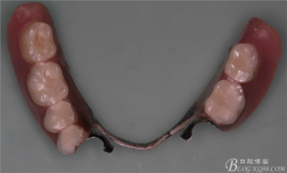 重度牙周炎的咬合重建修復(fù)兩年后效果--塘沽牙醫(yī)吳世超 重度牙周炎的咬合重建修復(fù)兩年后效果--塘沽牙醫(yī)吳世超