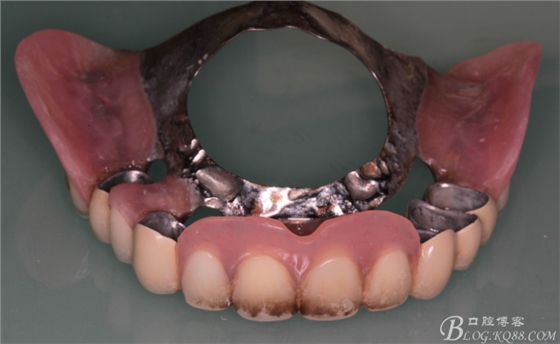 重度牙周炎的咬合重建修復(fù)兩年后效果--塘沽牙醫(yī)吳世超 重度牙周炎的咬合重建修復(fù)兩年后效果--塘沽牙醫(yī)吳世超