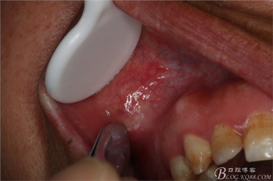 上頜磨牙區(qū)囊腫摘除+根尖切除術(shù) 上頜磨牙區(qū)囊腫摘除+根尖切除術(shù)