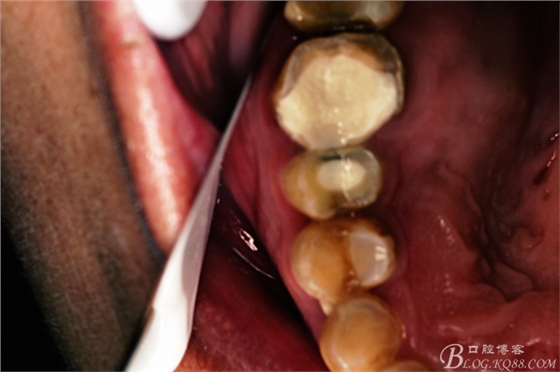 上頜磨牙區(qū)囊腫摘除+根尖切除術(shù) 上頜磨牙區(qū)囊腫摘除+根尖切除術(shù)